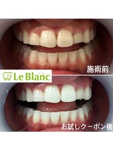 ルブラン 奈良店(Le Blanc)/【ホームホワイトニングと併用】
