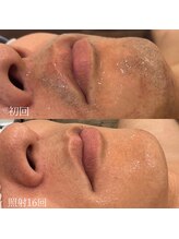 ダリオムズ 西宮北口(DAHLI HOMMES)/☆メンズヒゲ脱毛☆施術16回目