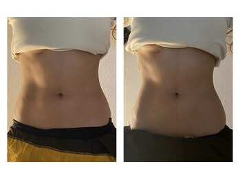 ティーツリー(tea tree)/腸もみ(左)ビフォー(右)アフター