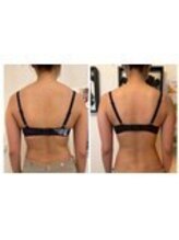 美人バスト 表参道店/バストアップ症例/育乳/1回目