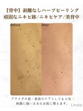 リンダ 西宮店(LINDA)/背中のニキビやシミケア