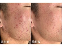 キビック(KIBIK)の雰囲気（【プラズマニキビケア】お肌の悩みもプラズマシャワーで改善♪）