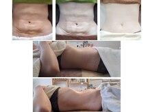 インディバサロン テスタ(testa)の雰囲気（上→術後ケア(5回)　　下→インディバ+腸セラピー(１回)）