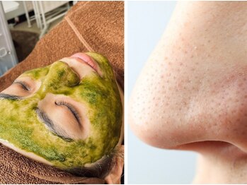 デューン 蕨店(Dune)の写真/口コミ5.0★リピ率◎【毛穴洗浄+幹細胞ハーブピーリング】SETの相乗効果でより毛穴レス肌へ!いちご鼻にも◎