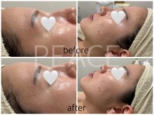 ピース(PEACE)/クリスティーナ　ミューズ１回