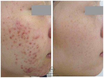 アンレミューラボ(Un Lemieux Labo)/毛穴、赤み跡改善