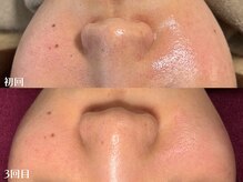 ヒーリングハーツ(Healing Hearts)/毛穴レス素肌に♪生まれ変わり☆