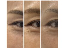アネラ キキ サロン(anela kiki salon)の雰囲気(水光ボツリヌスフェイシャル「ボニックス」2週間ごとの変化)