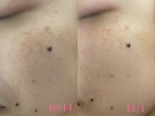 サクラ(SAKURA)/本厚木/フェイシャル/シミ