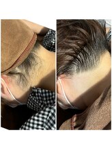 ボンダイボディー(Bondi Body)/うなじ脱毛