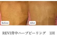 マテオ(Matteo)/背中ハーブピーリング