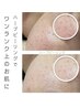 【美白度・つるつる度70％UP】ハーブピーリング★目で見えるお肌変化！！