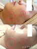 【メンズフェイシャル】どんな肌悩みも　臍帯由来ヒト幹細胞フェイシャル
