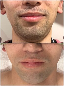 ネシア(nesia)/メンズヒゲ脱毛