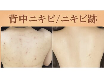 スリリアン 銀座/★ニキビ劇的ビフォーアフター★