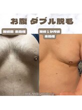 ビビユー(bibi u)/お腹ダブル脱毛ビフォーアフター