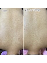 おうちサロン ミキ/背中などボディのピーリング人気