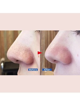 レプス(Lepus)/ハイドロフェイシャル