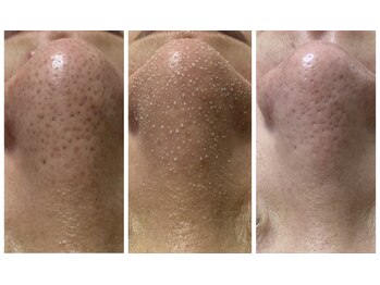 ルアナ(Luana)/【韓国式3D毛穴洗浄】