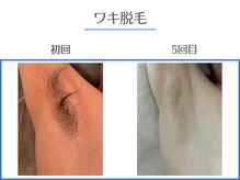 エクシアホワイトニング 岡崎店/メンズOK◇濃いワキの脱毛にも！
