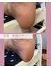 ¥3,500→¥2,500夏限定【足裏角質ケア】