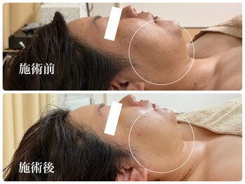 キーオブフェイス(Key of Face)/フェイスラインのたるみは脂肪？