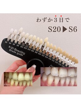 ブリエ(BRILLER)/《医》高効果ホワイトニング症例