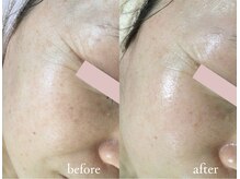 トリートメントルーム フェリーチェ(Felice)/４０代/艶めくハリ肌！