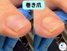 【巻き爪予防に】巻き爪ジェル　初回1指￥7,700→1指￥5,500～