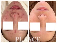 プランス 福岡(PLANCE)/ニキビ改善福岡天神エステ