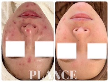 プランス 福岡(PLANCE)/ニキビ改善福岡天神エステ