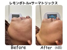 ラディアント たまプラーザ/レモンボトル×サーマトリックス