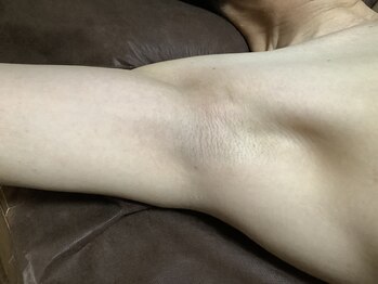 ダンディラボ(Dandy Lab)/メンズ脇脱毛