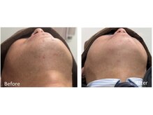 リッカ 学芸大学(RIKKA)/ひげ脱毛