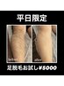 【平日男性限定】短パンが似合う男に!足脱毛プラン1回5000円