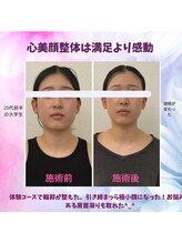 ハナノ整体院/猫背と巻肩が改善され顔が立体感