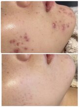 アトワ(A toi)/ハーブピーリング　ハードタイプ