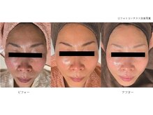 ベルメイク(BELLE MAKE)/水光ピール☆ビフォーアフター