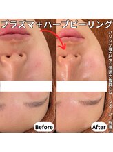 ベルファーム(Belle Femme)/プラズマ＋ハーブピーリング