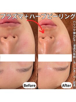 ベルファーム(Belle Femme)/プラズマ+ハーブピーリング