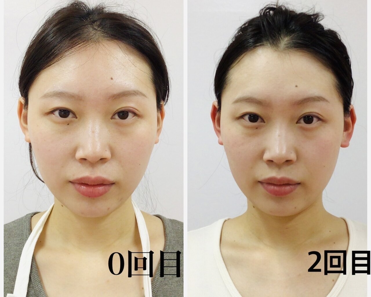 蓄熱式　ハイ○の代わり　エステ　小顔 蓄熱式 ハイ○の代わり エステ 小顔 （KOZY Beauty Salon）