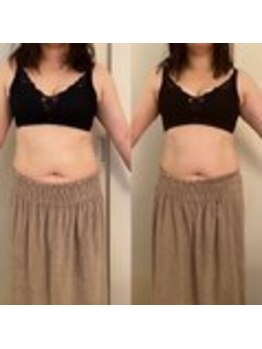 美人バスト 表参道店/【症例写真】痩身