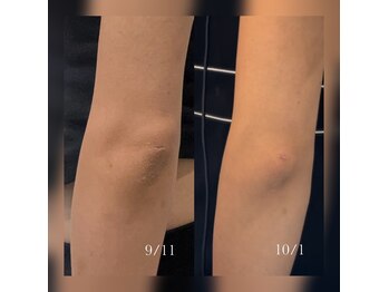 クレビア(CREBIA)/黒ずみメラニンケア♪♪