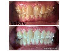 歯の内部から白くなるホワイトニングは1日に３照射で効果が高い