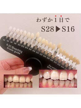 ブリエ(BRILLER)/《医》高効果ホワイトニング症例