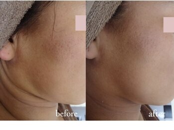 トリートメントルーム フェリーチェ(Felice)/ 二重アゴ払拭/顎下スッキリ