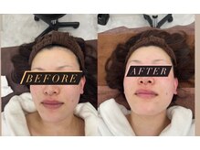 徳島美容サロン/クリスタルショットコース