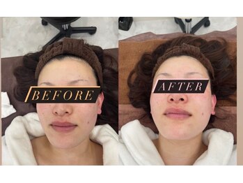 徳島美容サロン/クリスタルショットコース