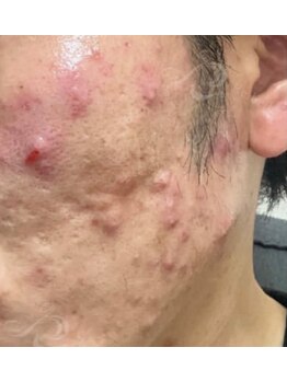 リベル 名古屋(Lebelle:)/ハーブピーリング専門名古屋