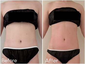 カレンジェビューティー(CarengeBeauty)/スリムカッター